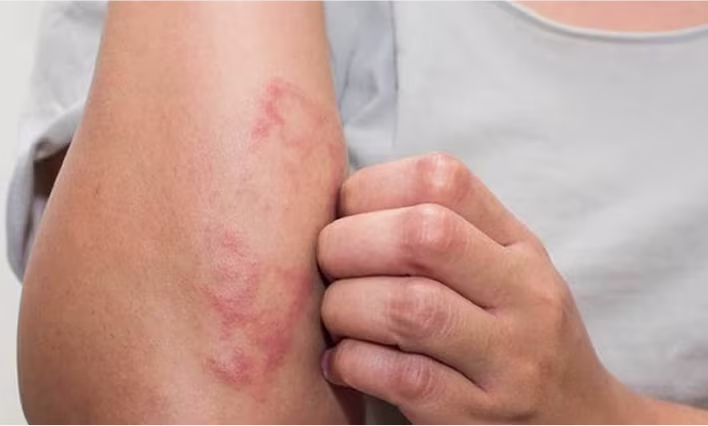 Close-up of itchy eczema rash on an arm needing soothing therapy.