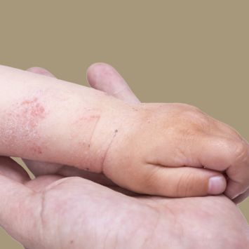 Eczema Prone Baby Skin