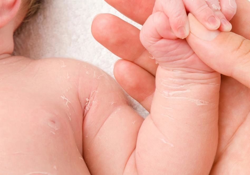 baby dry skin hero