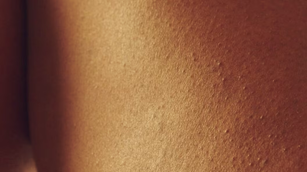Uneven Tone and Texture Skin