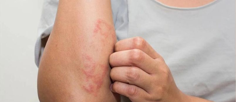 Image showing a person's arm affected by a rash illustrating the visible signs of skin itchy