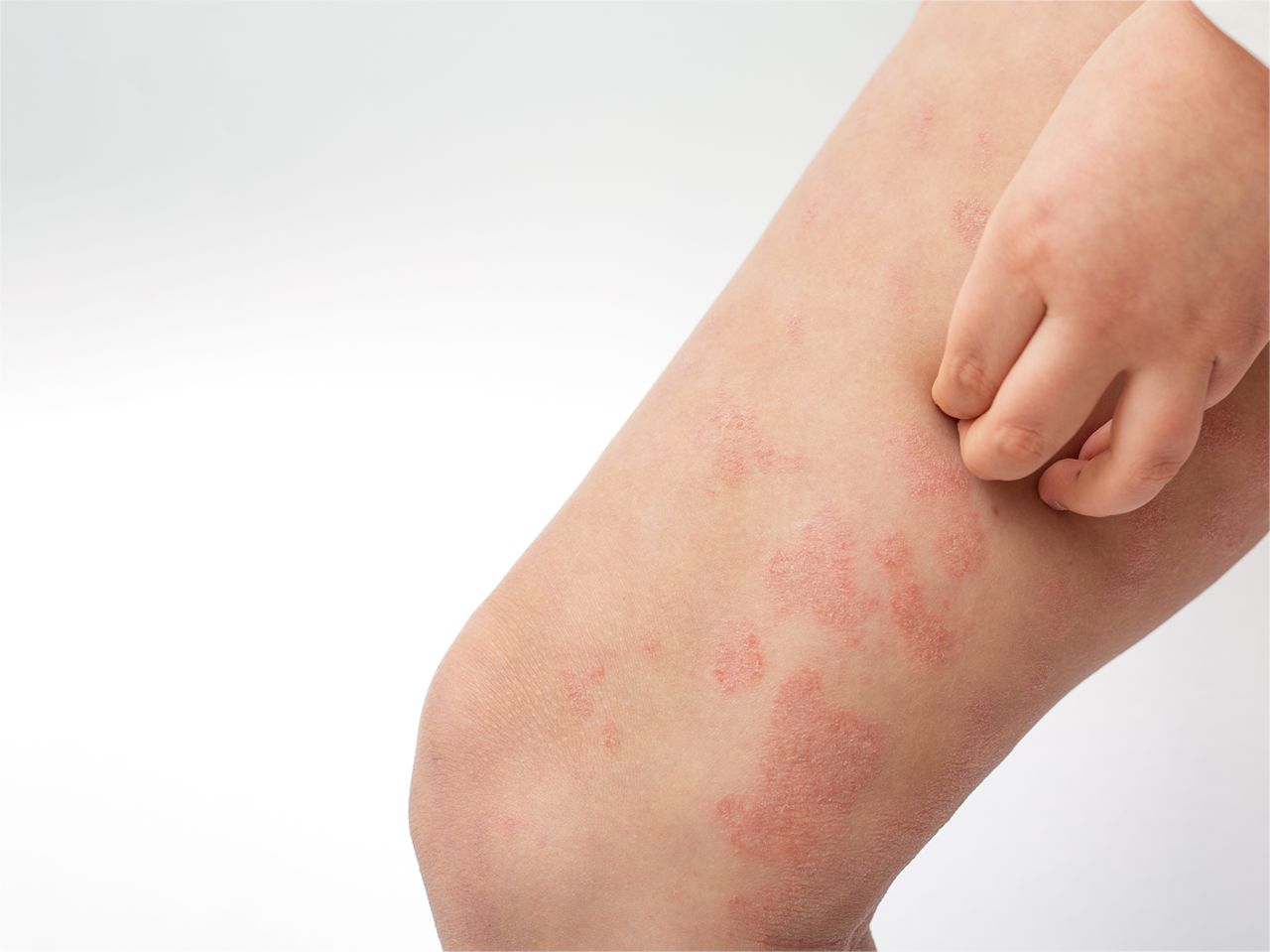 Psoriasis: