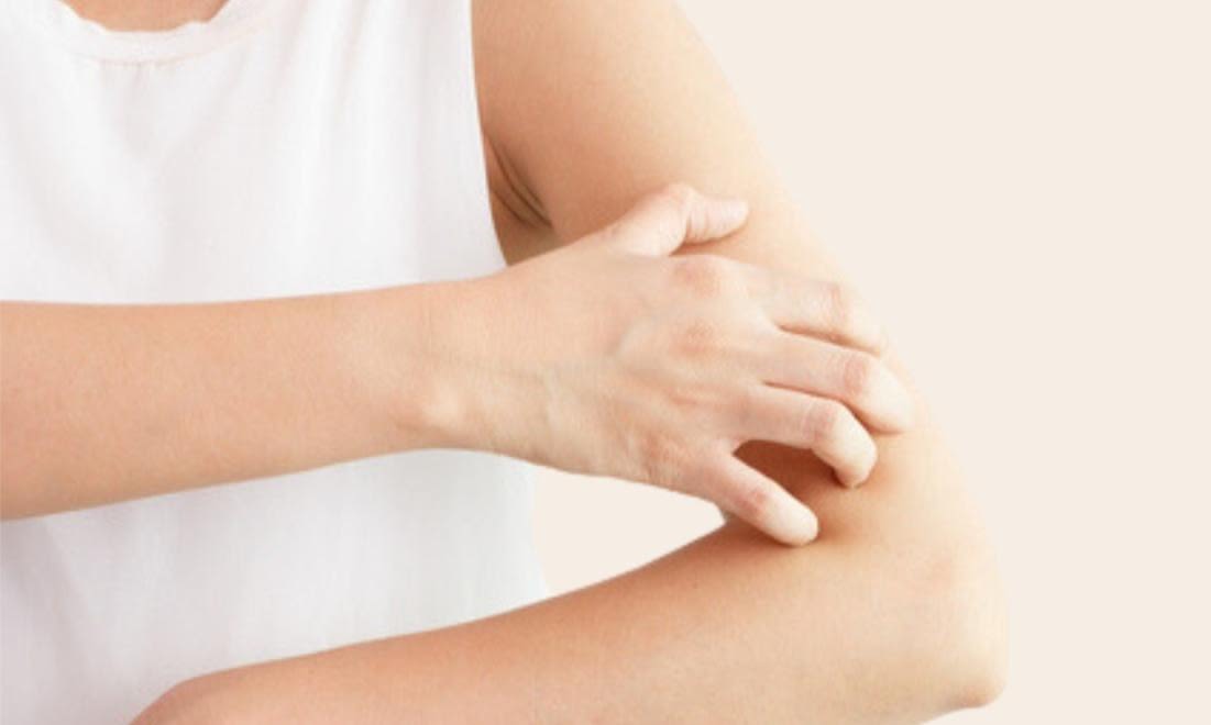 Eczema-Prone Skin