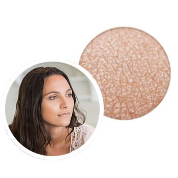what-is-eczema