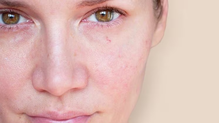 Redness skin banner with a close look to a woman's face, she have some redness on skin