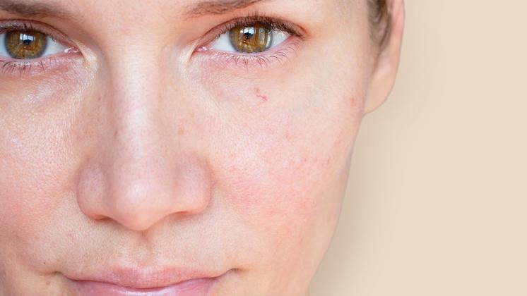 Redness skin banner with a close look to a woman's face, she have some redness on skin