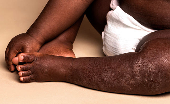 Close up of diaper-clad baby's legs as they sit on the floor, appearing to have a skin condition on their knees and shins