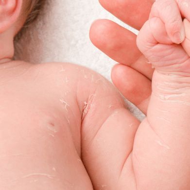 Dry, Itchy Skin