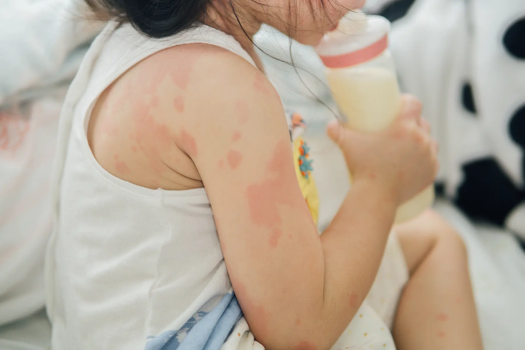 A child with allergies on her arms and back.