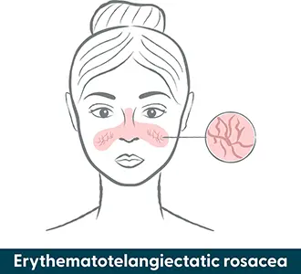 Erythematotelangiectatic rosacea infographic