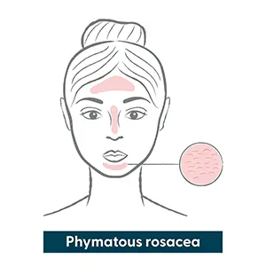 Phymatous rosacea infographic