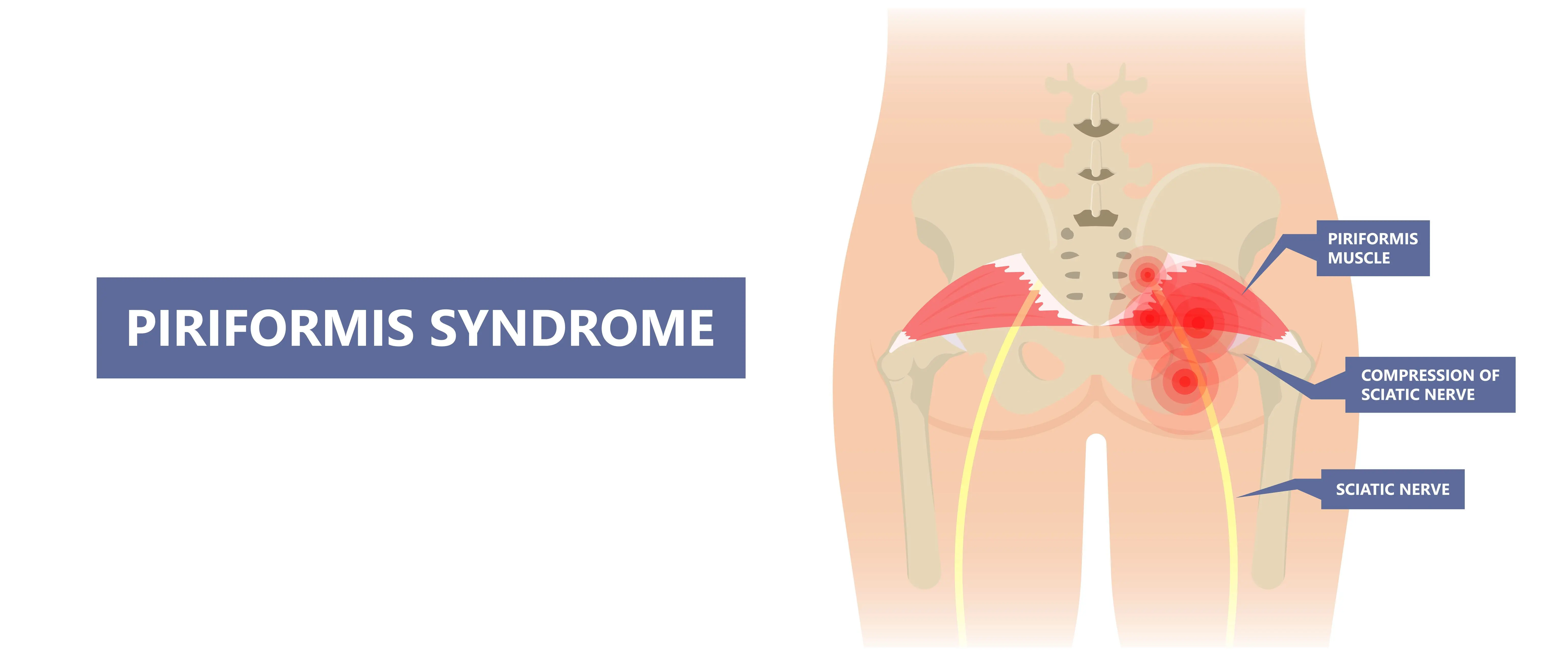 A diagram drawing explaining Piriformis syndrome