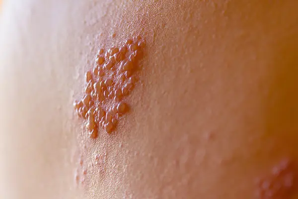 What Does Shingles Look Like When it First Starts