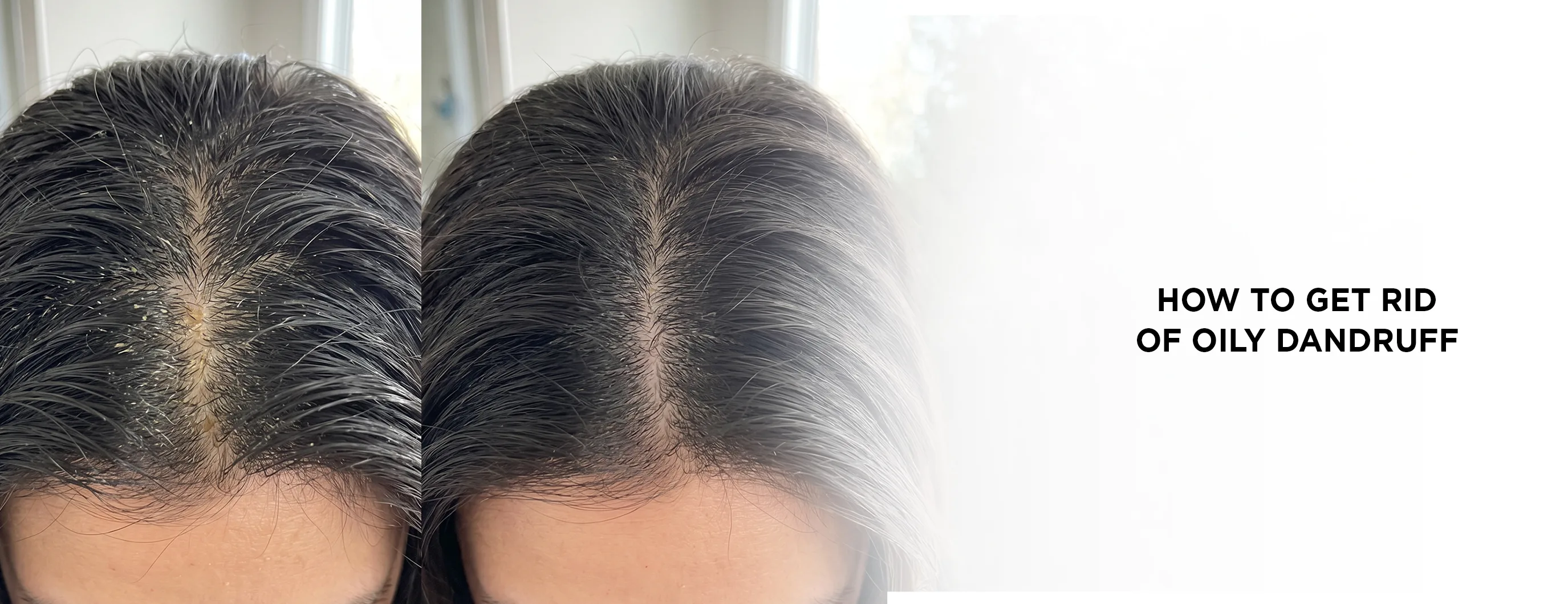 How to get rid of oily dandruff
