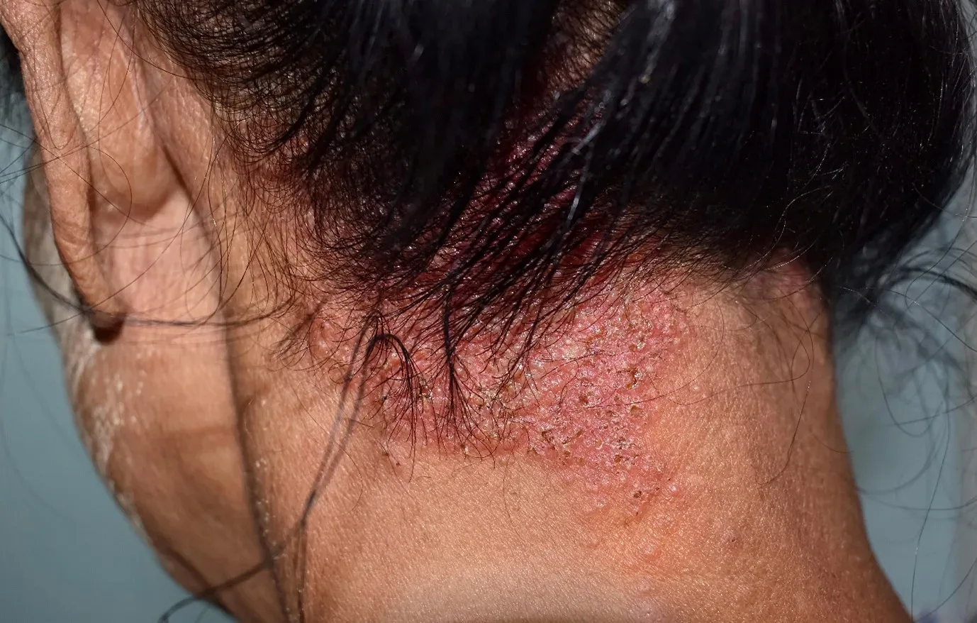 Seborrheic dermatitis on scalp showing flakes, redness, itching and scalp irritation