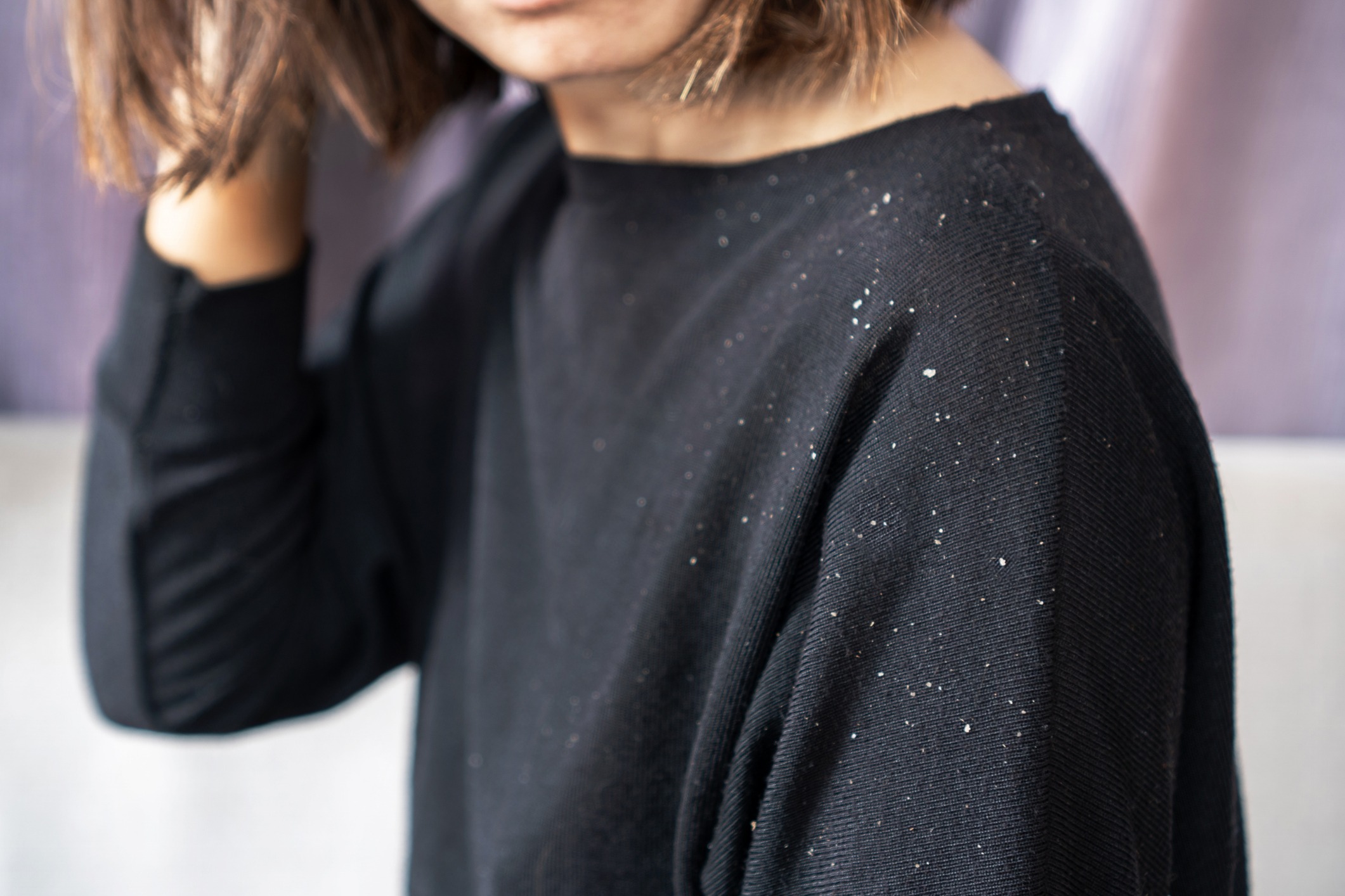 Why do I have dandruff.