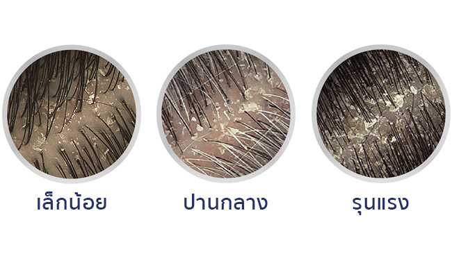 ประเภทของรังแค - ศีรษะและไหล่