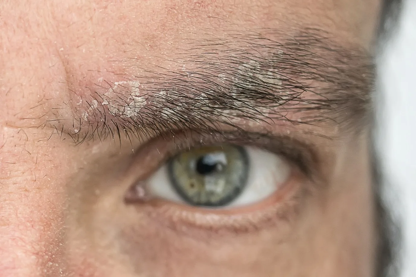 Dandruff on Eyebrows