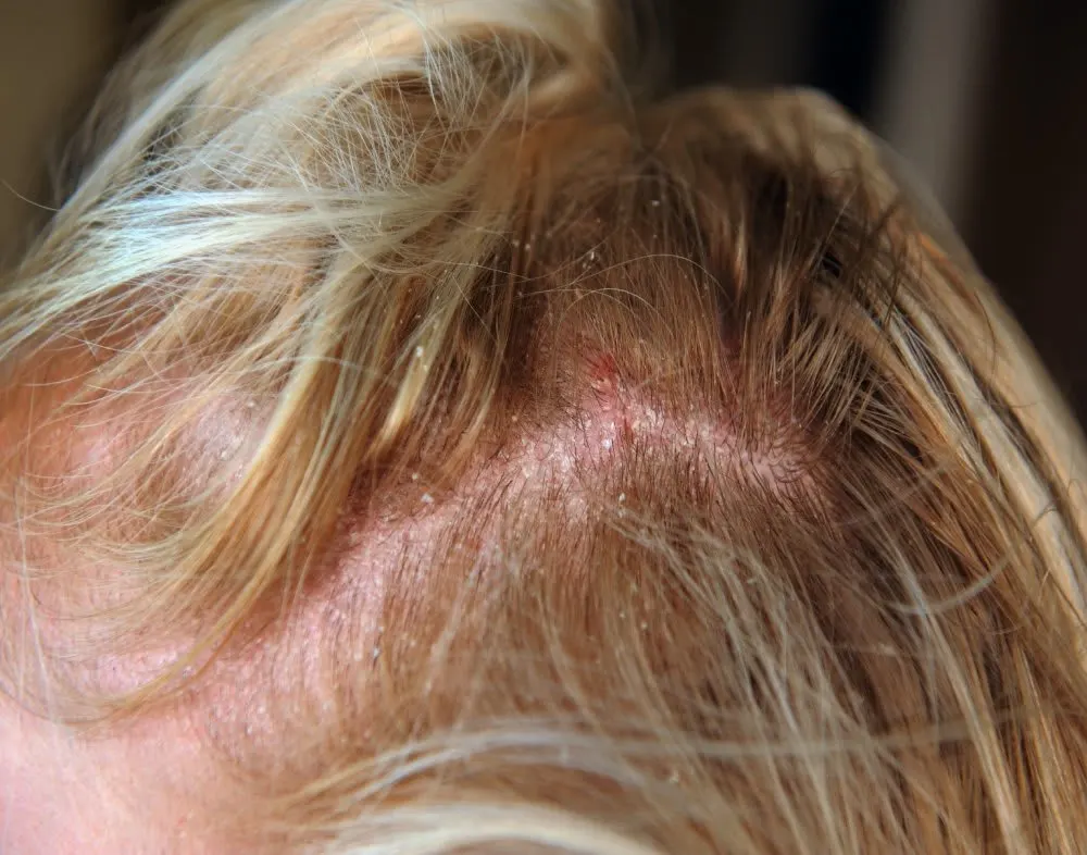 THE DO’S AND DON’TS OF HAIRCARE WHILE DEALING WITH SCALP REDNESS