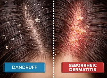 A split comparison visual showing two scalp conditions—one side with mild flakes (dandruff) and the other with redness and thicker scales (seborrheic dermatitis), clearly labeled for comparison.