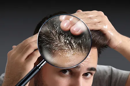 A close-up visual of oil being applied to a flaky scalp, highlighting the impact of excess oil.
