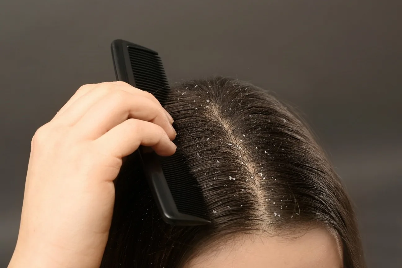 Dandruff comb to remove dandruff