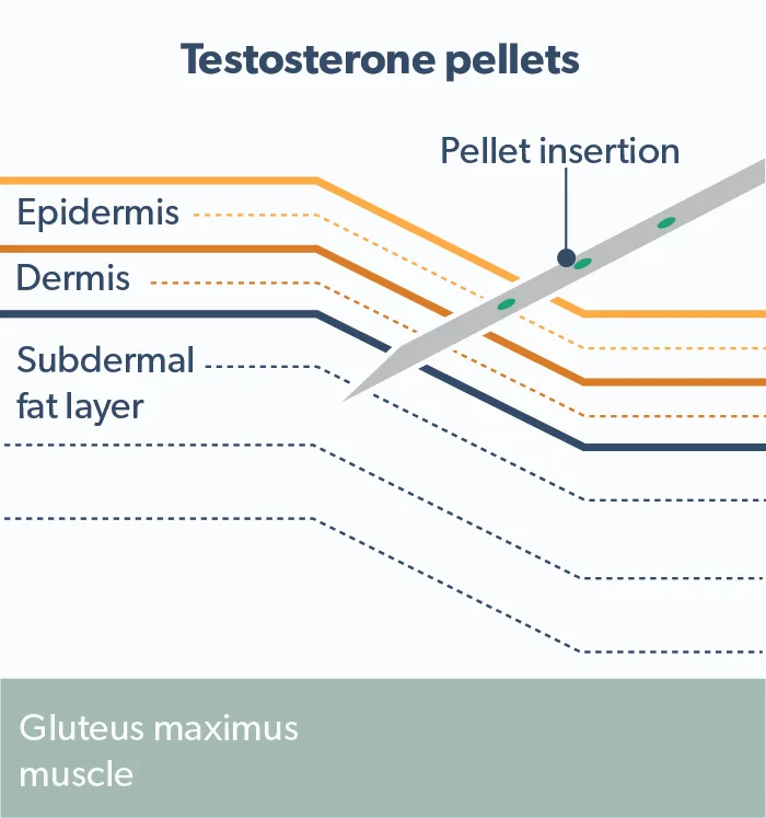 OC Testosterone pellets: an option for testosterone replacement therapy image 0c2d48d0-2575-4bed-914f-75ad02ef603b