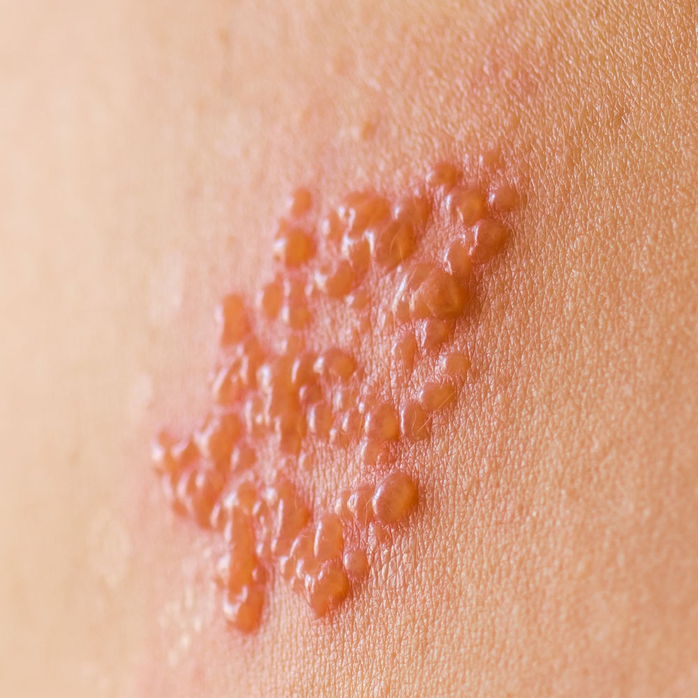 Can You Take Valacyclovir and Alcohol? Is It Safe? | Ro