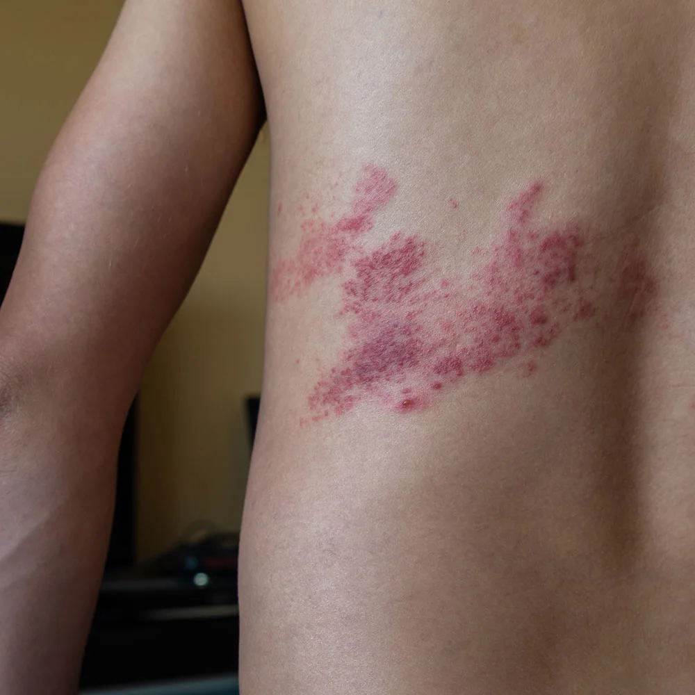 Herpes: what you need to know about this family of viruses - Desktop Image