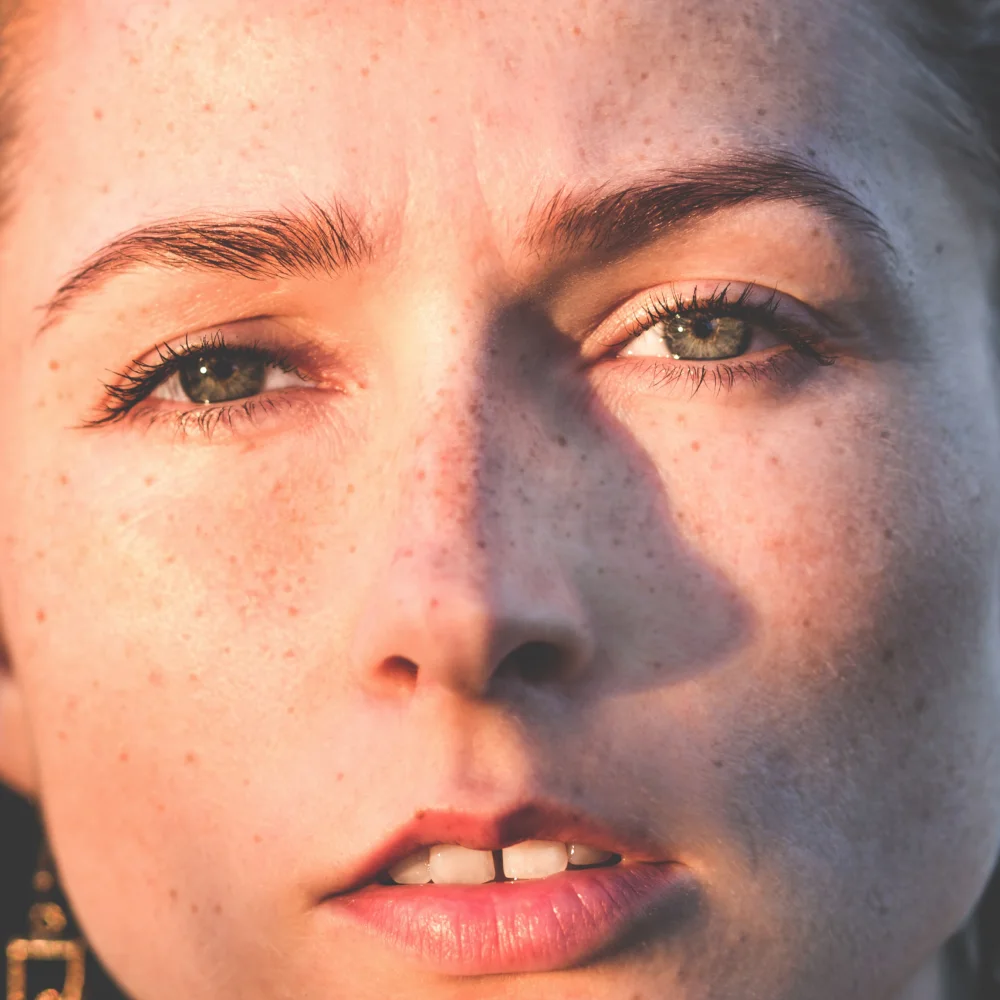 Hyperpigmentation: what is it, causes, and how to get rid of it - Desktop Image