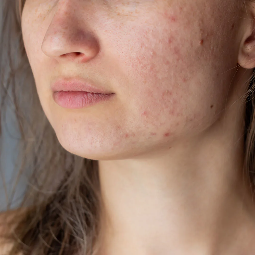 Spironolactone for acne: uses, benefits, side effects - Desktop Image