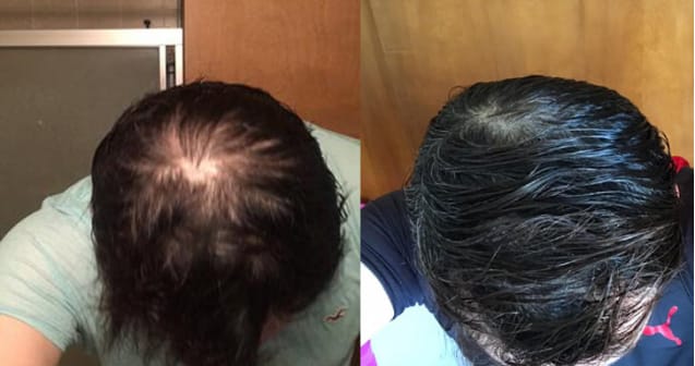 Hair Loss Treatment - Alopecia Medications & Solutions | Ro
