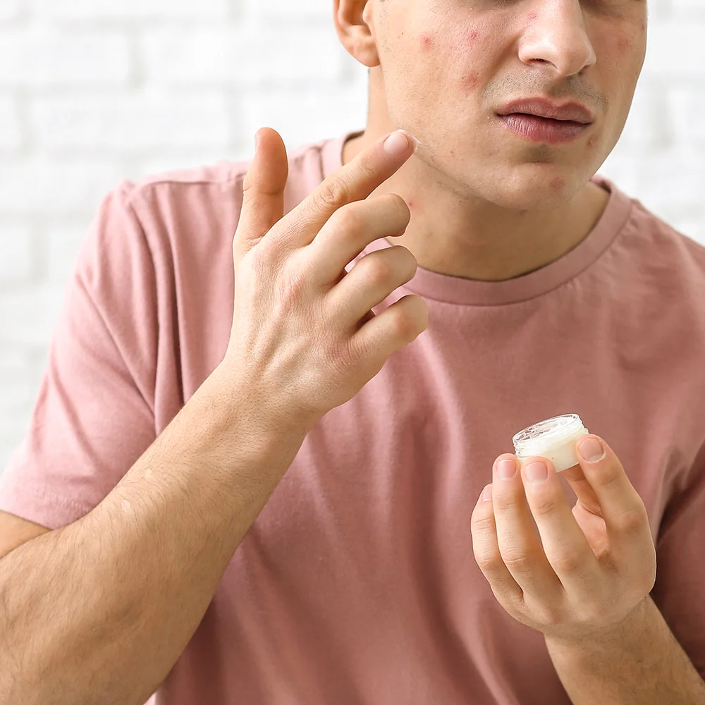 Types of acne treatments - Desktop Image