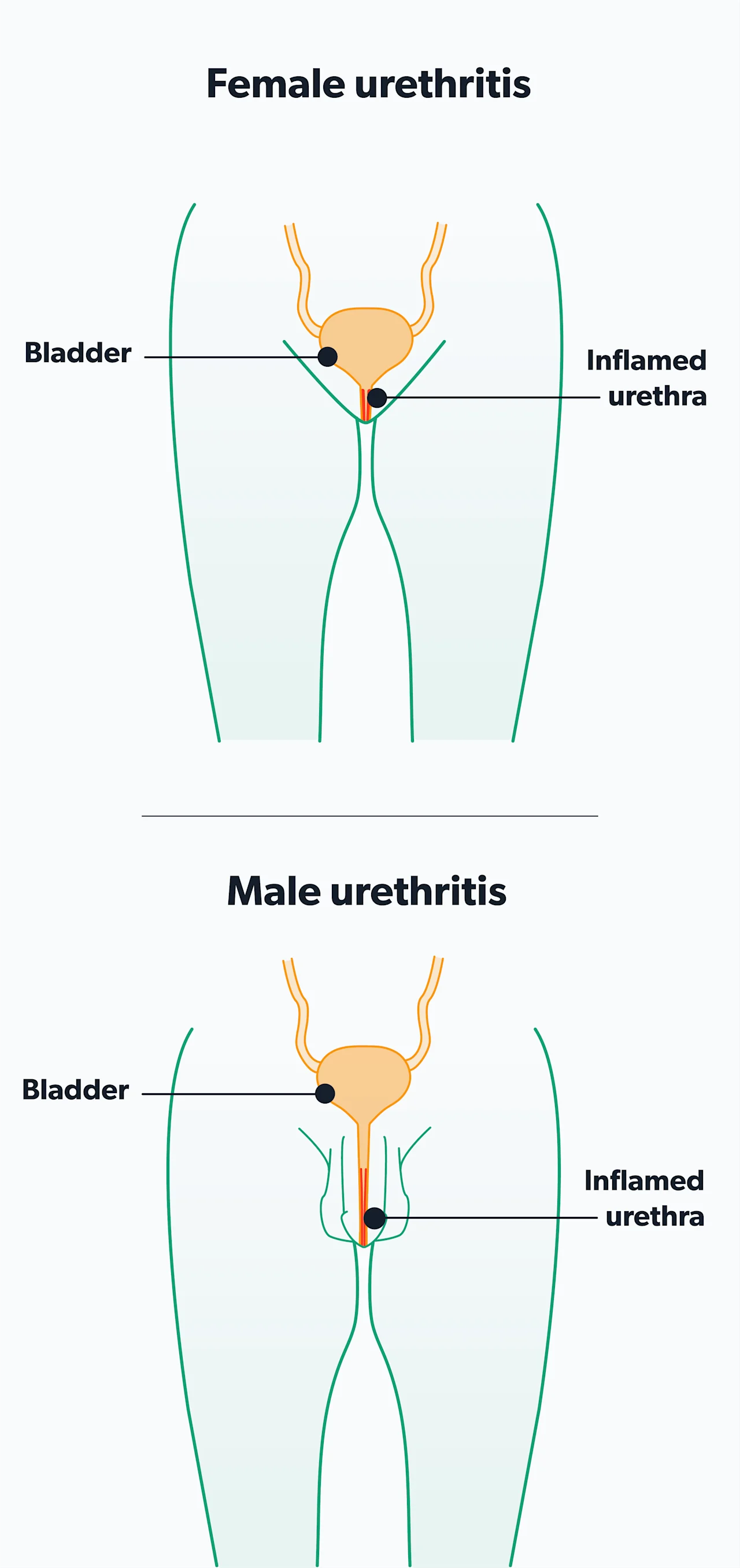 OC Chlamydia: symptoms, diagnosis, risk factors, and treatment image 323c4780-4e7c-4f47-9107-435d03944c38