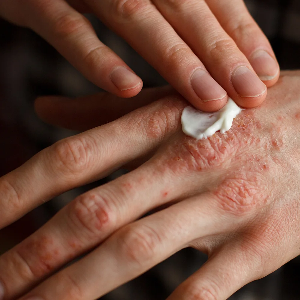 Types of psoriasis: symptoms, causes, treatment - Desktop Image