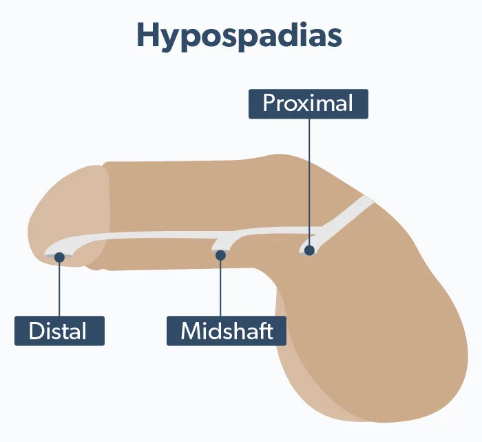OC Hypospadias: urethral opening misalignment image 41d56371-2af9-4ebb-b7a0-a87f8a945d65