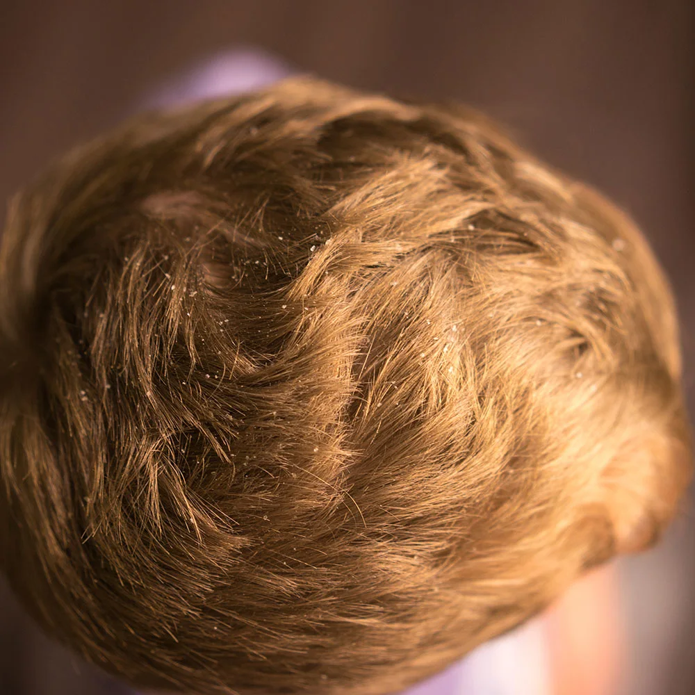 Dandruff causes—how knowing them may solve the problem - Desktop Image
