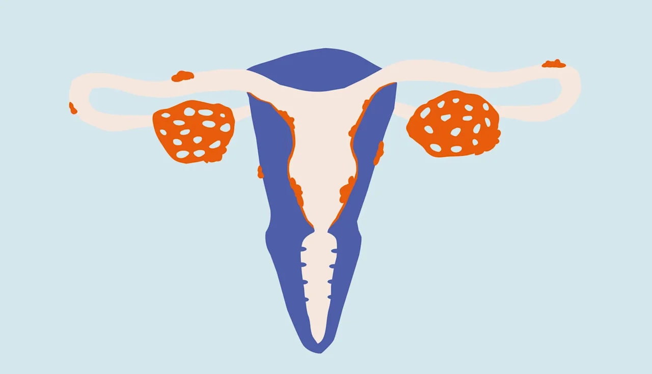 Endometriosis: a common condition the world doesn't seem to understand - Desktop Image