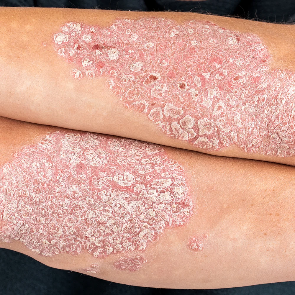 Plaque psoriasis: what is it, symptoms, treatment - Desktop Image