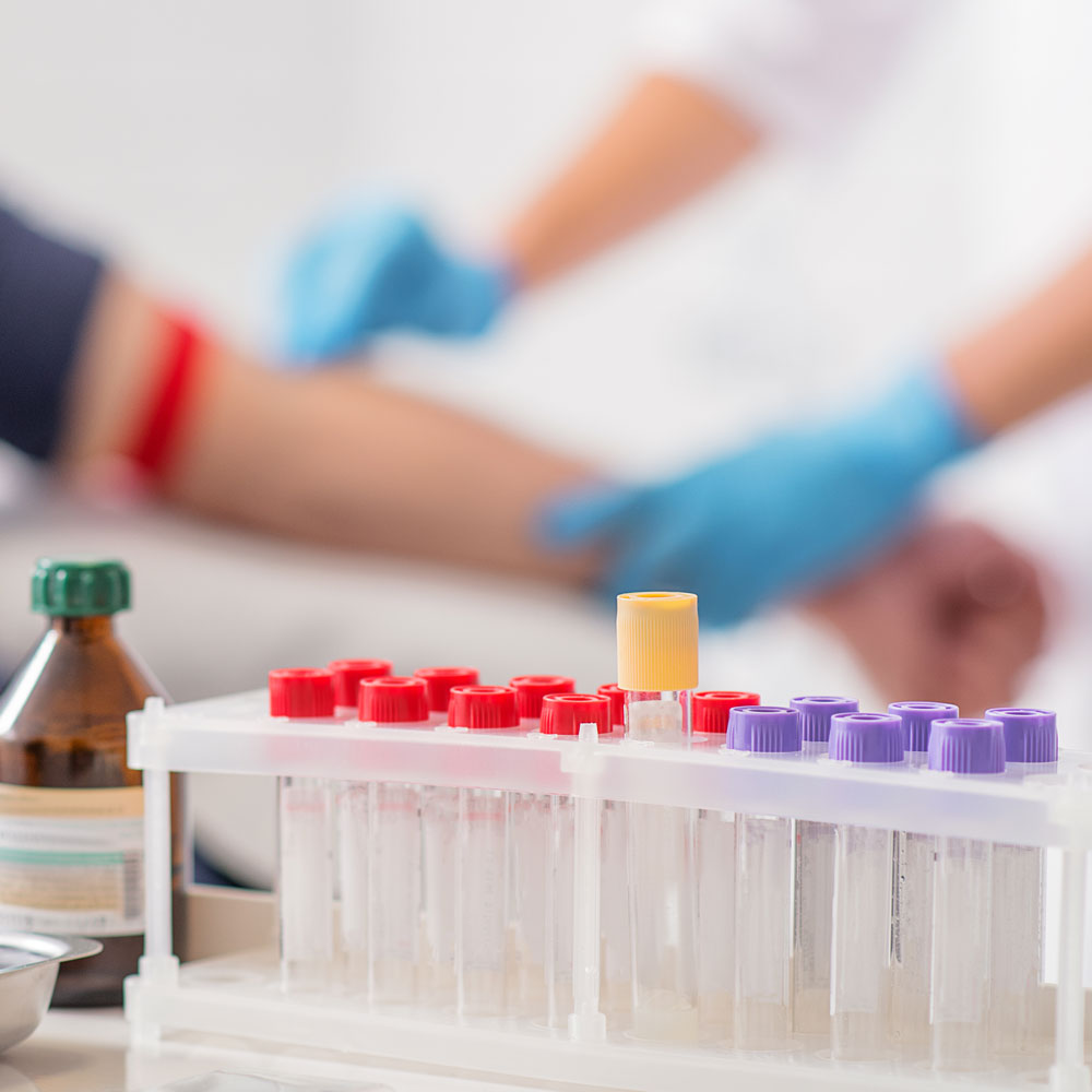 Vitamin D Blood Test What the Results Mean Ro