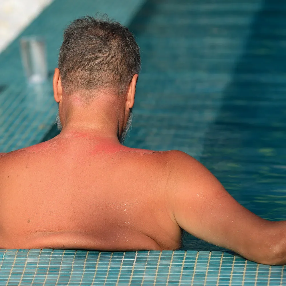 What is sun-damaged skin (photoaging) and how to treat it - Desktop Image