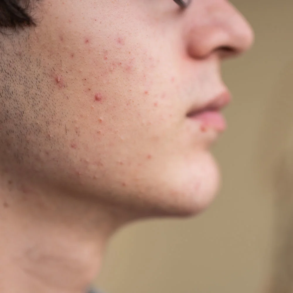 How to get rid of whiteheads - Desktop Image