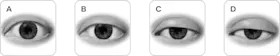 Ptosis Scale