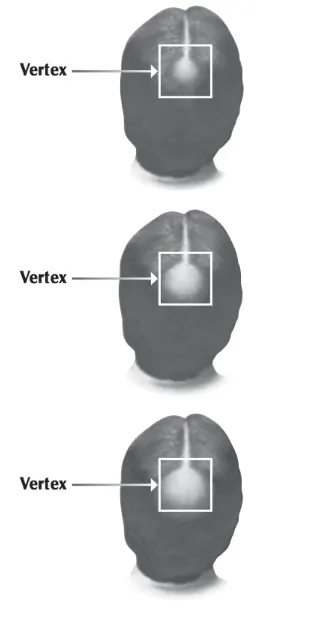Minoxidil and hair loss