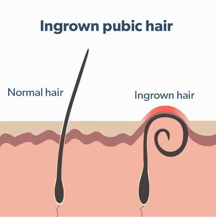 OC What is an ingrown pubic hair? image 7fb03aa1-70c2-4f1c-9234-469343f1dff5
