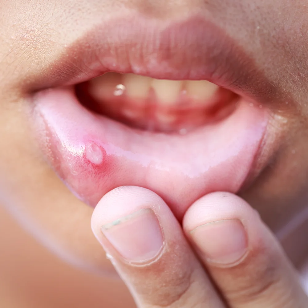 Common and serious side effects of valacyclovir - Desktop Image