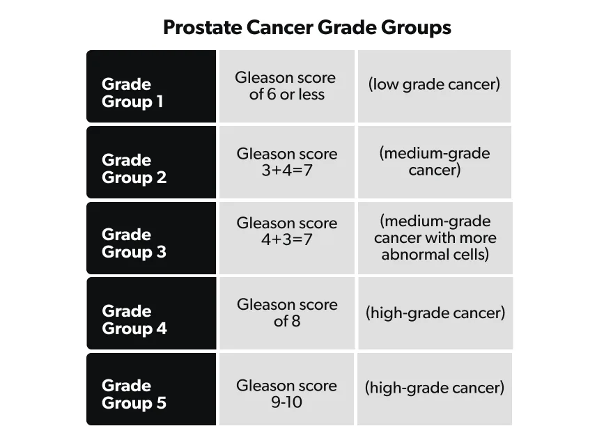 prostate-cancer-stages-grades-and-treatment-ro-man