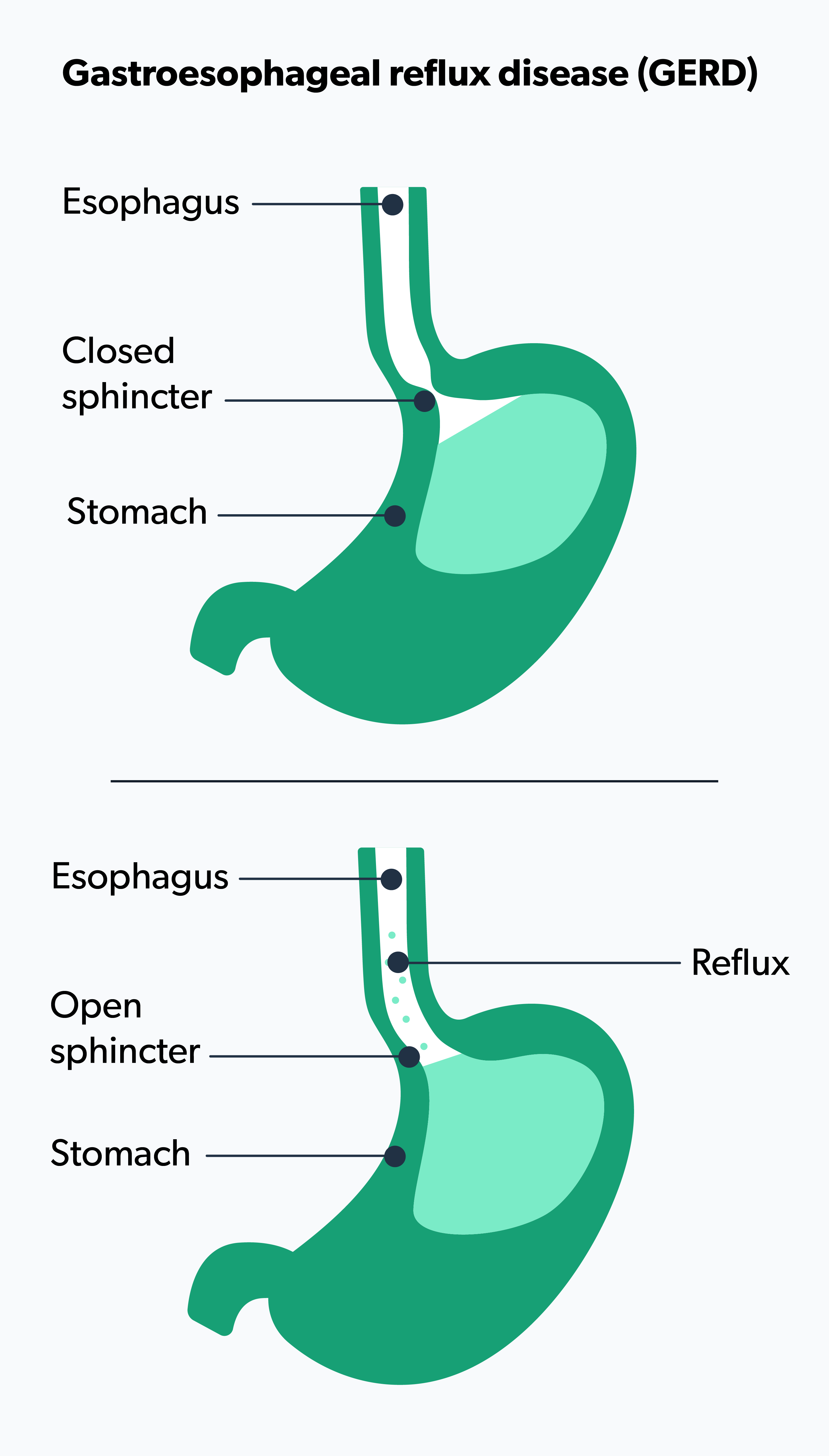 Acid Reflux Symptoms How To Tell If You Have GERD Ro