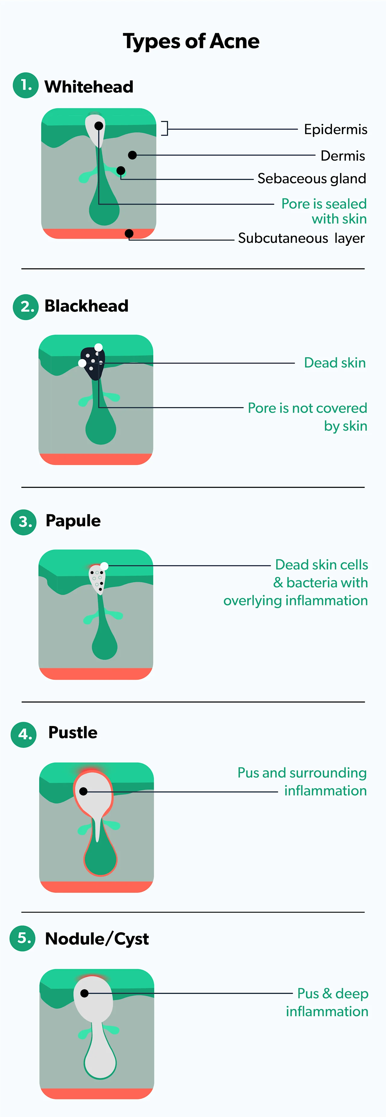 OC Adult acne: symptoms, causes, and treatments image 95853cce-6776-4cc1-bf0c-8fa77355a2ad