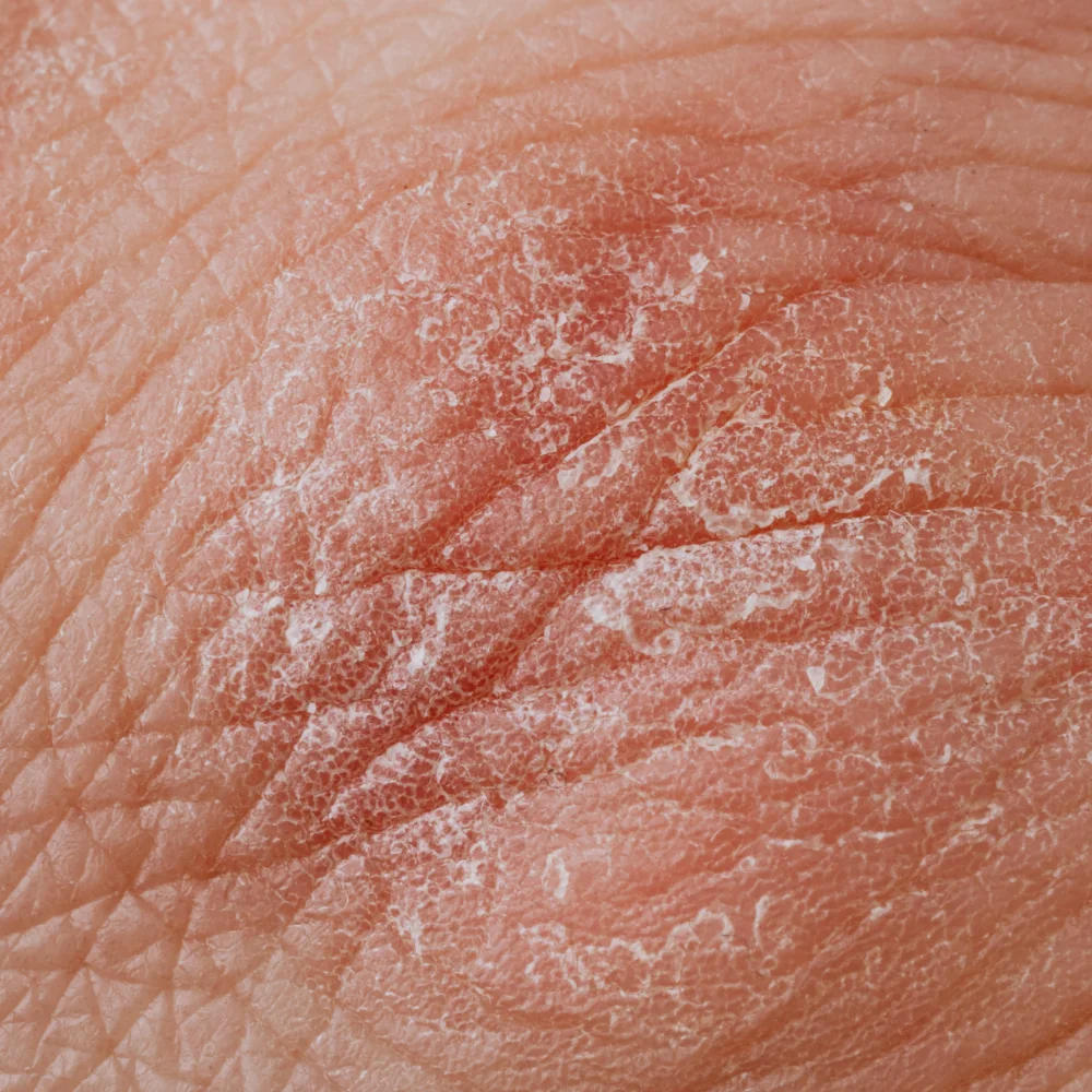 Psoriasis: what is it, causes, symptoms, treatment - Desktop Image